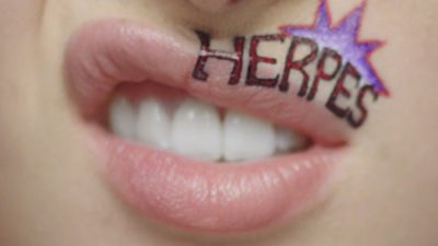 Herpes Labiale