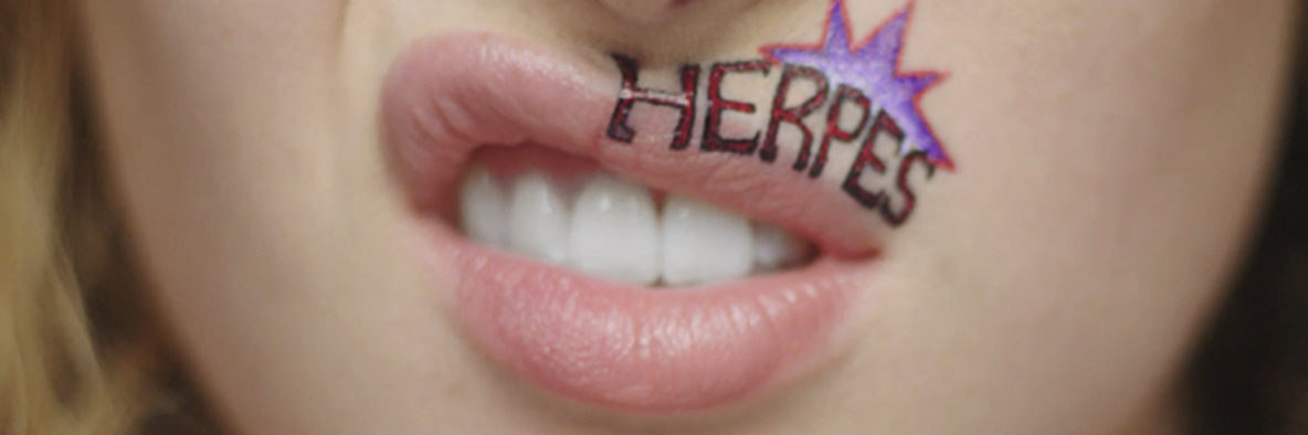 Herpes Labiale